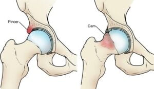 Femoro- acetabular Impingement Syndrome (FAIs)