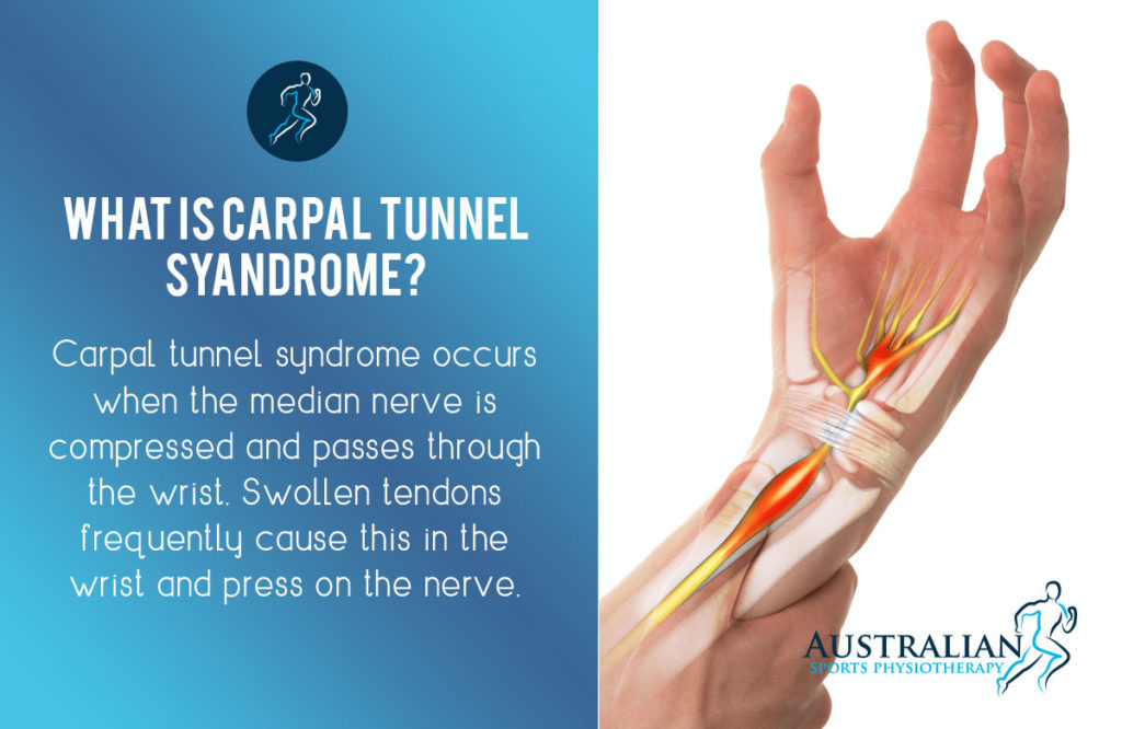 Carpal Tunnel Syndrome Physio | Australian Sports Physio