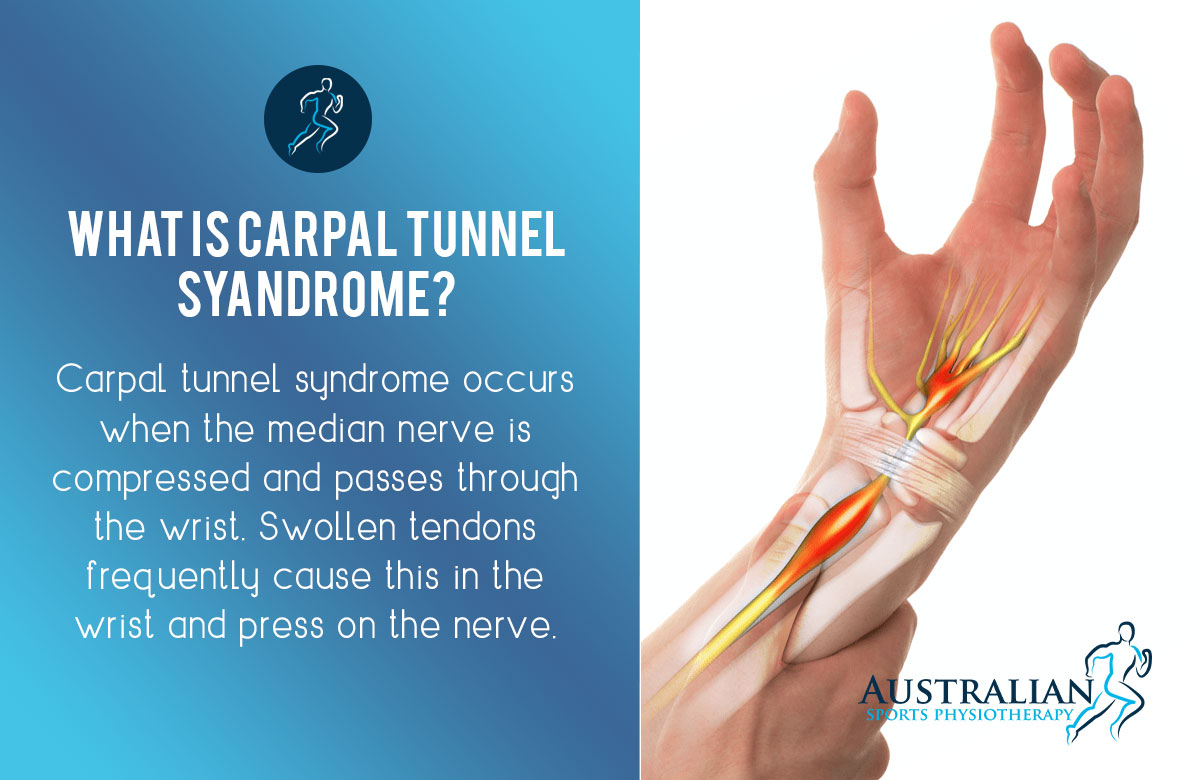 Physiotherapy for Carpal Tunnel Syndrome