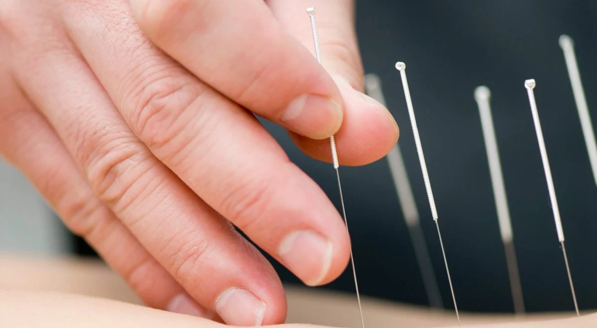 Dry Needling Service and Treatment | Australian Sports Physiotherapy