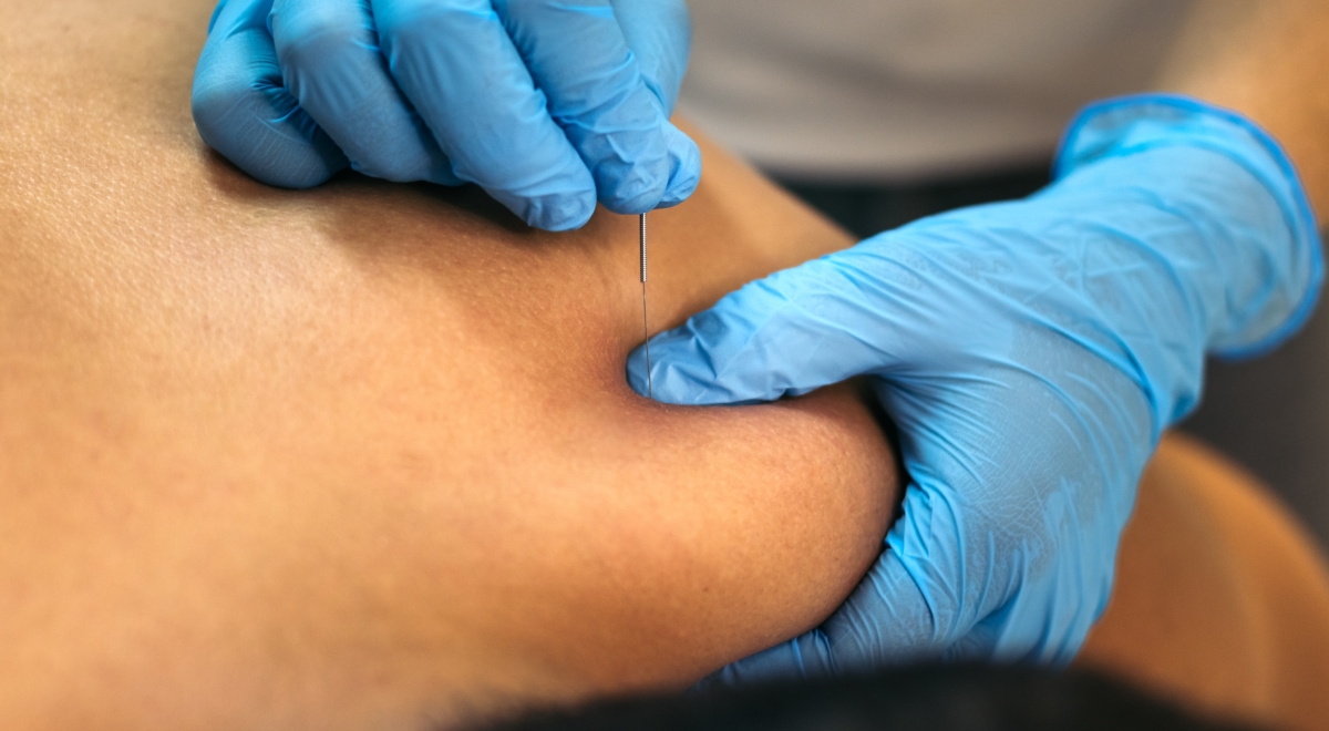 Dry Needling Service and Treatment | Australian Sports Physiotherapy